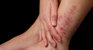 La farmacia hospitalaria estudia el impacto emocional de la psoriasis