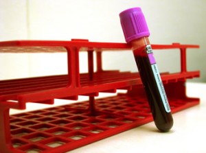 Un análisis de sangre puede predecir la supervivencia en cáncer de próstata metastásico