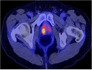 ¿Eres paciente de cáncer de próstata? Participa en esta encuesta