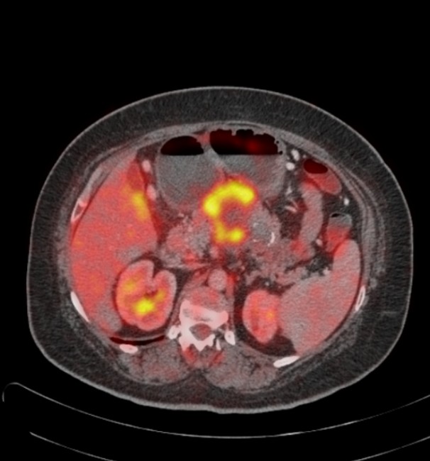 Posible tratamiento de cáncer de páncreas | Somos Pacientes