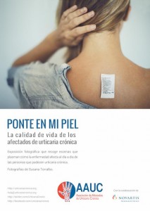 Exposición de la AAUC para concienciar sobre la urticaria crónica