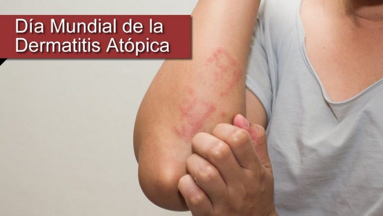 Este S Bado Se Celebra El D A Mundial De La Dermatitis At Pica Somos