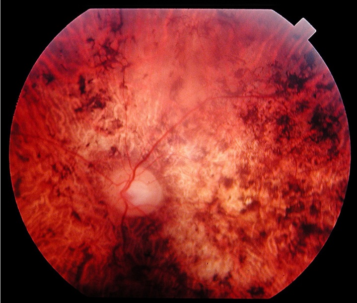 Ayudas para la investigación de las distrofias hereditarias de la retina