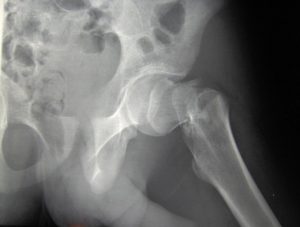 Prevenir cada año 1.200 fracturas óseas por la osteoporosis