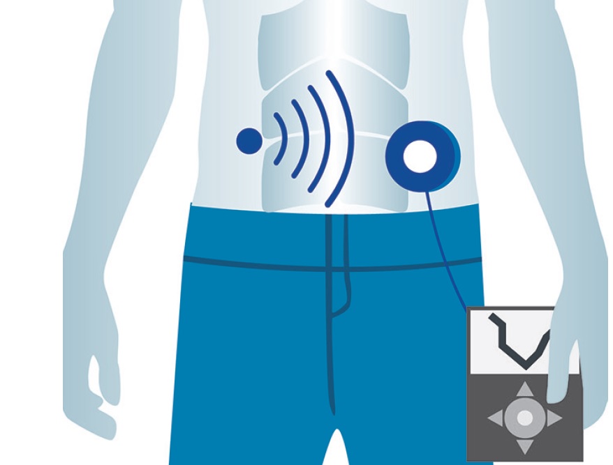 Paliar las inequidades en el acceso a los sistemas de asa cerrada en la diabetes